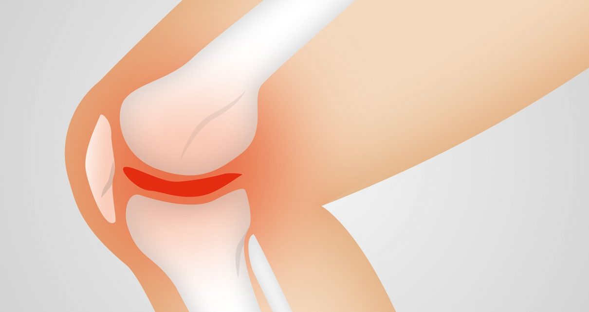 Arthrocalman Osteoarthritis Knee  - naturwohl-gesundheit / Pixabay