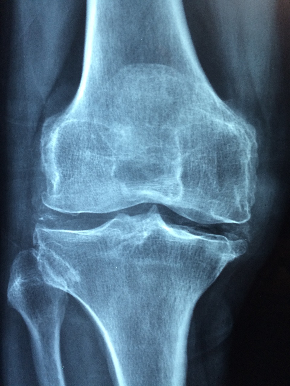Knee Old Care Injury Pain - Taokinesis / Pixabay